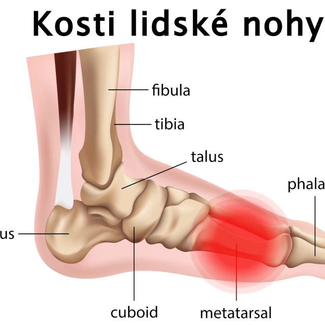 Bolest chodidla pod prsty při došlapu