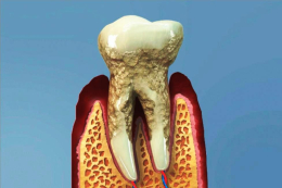 Parodontóza - skrytý strašák v ústech